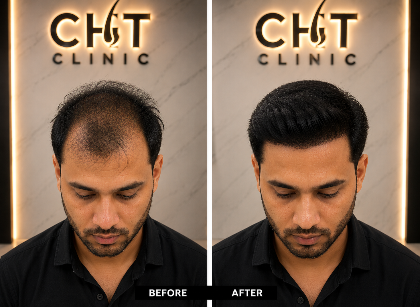 Hair Transplant Result